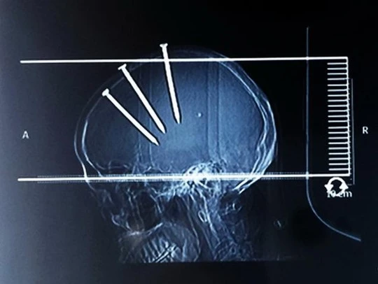 3 cây đinh cắm sâu vào hộp sọ. Ảnh: REX USA