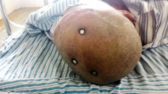 Người đàn ông được đưa đến bệnh viện trong tình trạng đinh cắm sâu trong đầu. Ảnh: REX USA