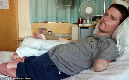 Mất 3 chi và nửa khuôn mặt do vi khuẩn “ăn thịt người”