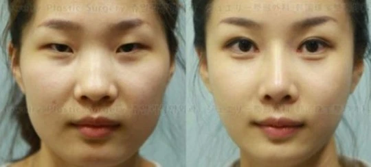 Nhập cảnh không được vì quá đẹp sau giải phẫu thẩm mỹ