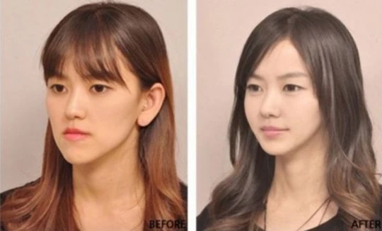 Cắt mí, nâng mũi là những ca phẫu thuật được bác sĩ Hàn Quốc thực hiện nhiều nhất