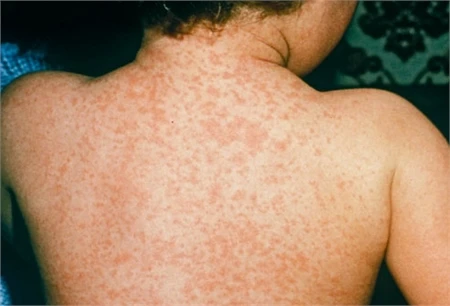 Các bệnh sốt phát ban: dễ nhầm lẫn! ảnh 3