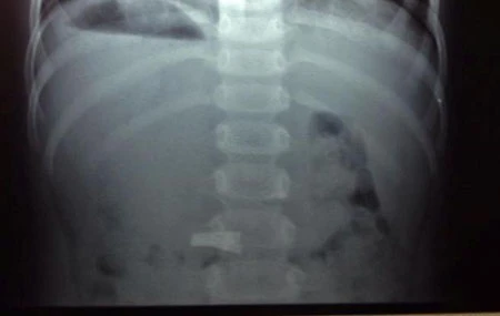 Kết quả chụp &nbsp;X.Quang cho thấy chiếc cặp yên vị quay ngang trong dạ dày bé