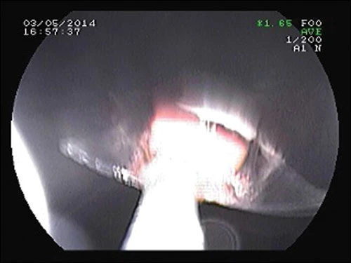 Suýt thủng ruột do uống thuốc còn nguyên vỉ ảnh 2