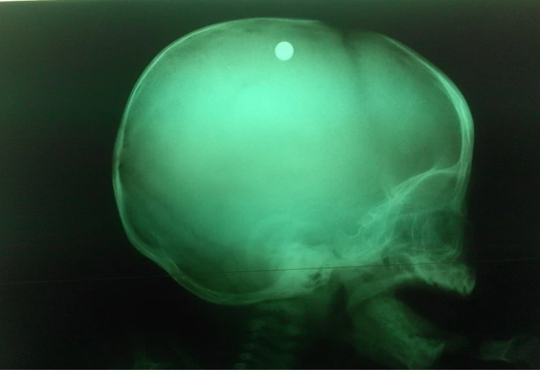 Trẻ bị đạn ghim vào đầu vì chị gái nghịch súng tự chế ảnh 1