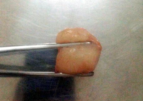 Quả vải gây ra cái chết thương tâm cho bé trai 6 tuổi