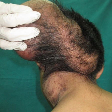 Khối u lủng lẳng nặng 1,5kg &nbsp;khiến bệnh nhân như là một người có hai đầu. Ảnh: BS cung cấp.