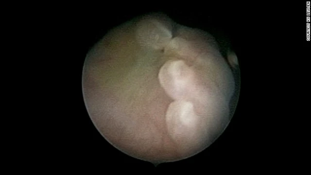 Cánh tay của thai nhi qua hình ảnh 3D của rô bốt.