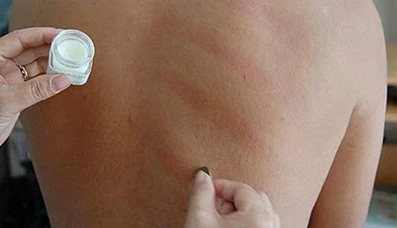 Cạo gió thế nào cho đúng?