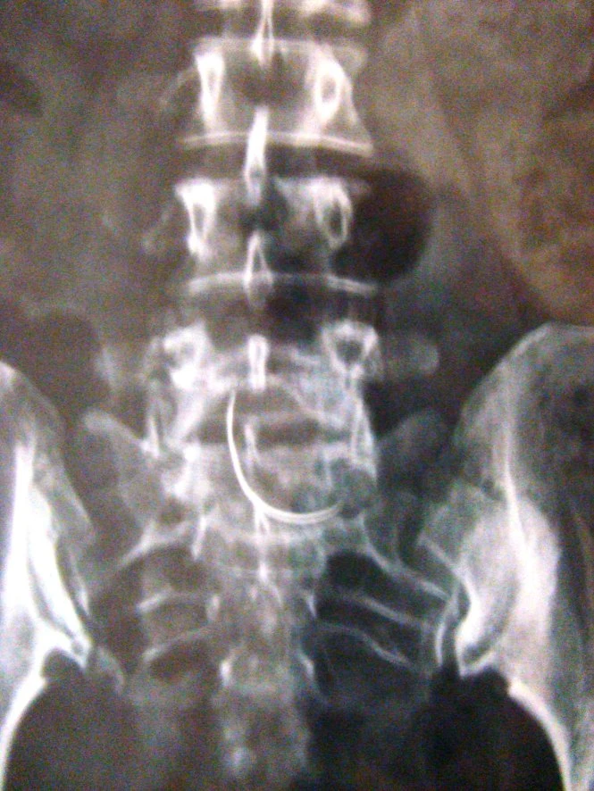 Cây kim trong bụng