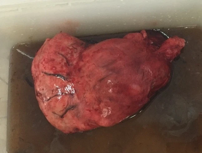 Nữ bệnh nhân bị u tử cung to hơn trái banh nằm trong bụng ảnh 1