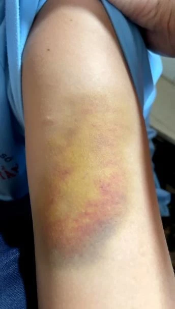 Em N.H.N bị nhóm bạn cùng trường đánh hội đồng đến 3 lần Em N.H.N bị nhóm bạn cùng trường đánh hội đồng đến 3 lần