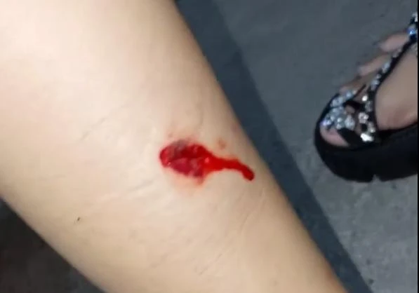 Bắp chân người vợ nghi bị trúng đạn