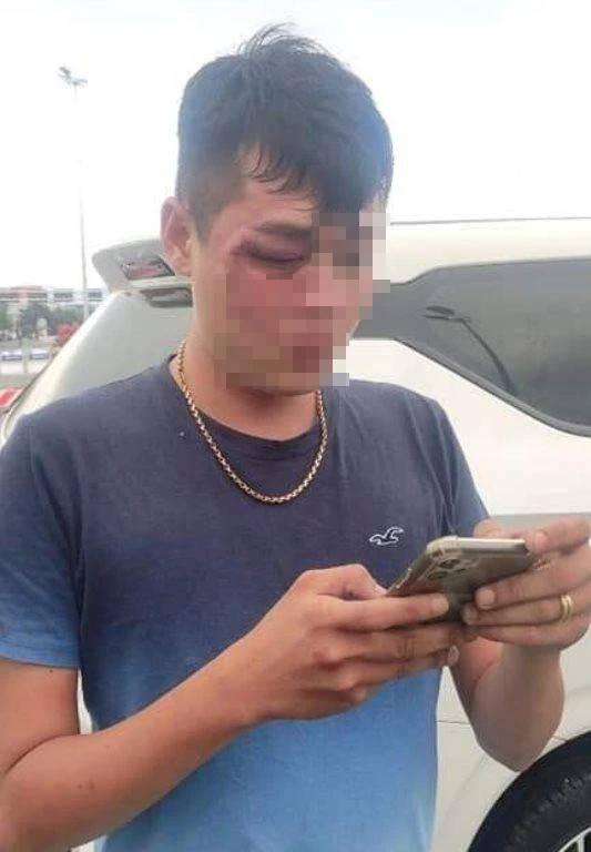 Tài xế Grab bị thương tích sau khi bị nhóm người hành hung. Ảnh: H.H Tài xế Grab bị thương tích sau khi bị nhóm người hành hung. Ảnh: H.H