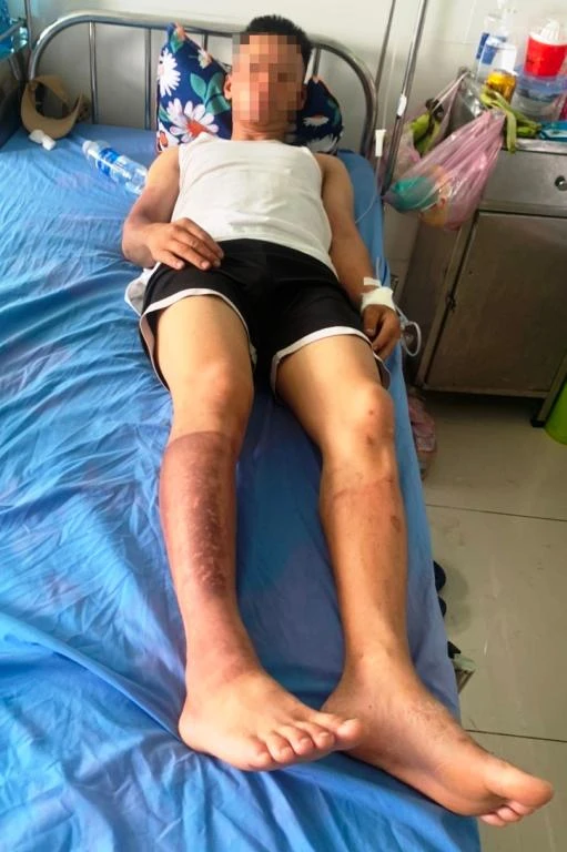 Cháu của ông G cũng bị bỏng sau khi bình xịt kiến phát nổ. Ảnh: H.H