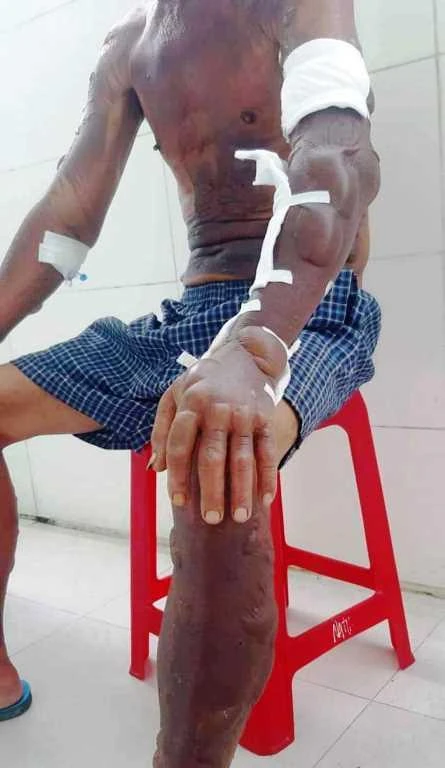 Người đàn ông bị bỏng khắp người do bình xịt kiến phát nổ. Ảnh: H.H