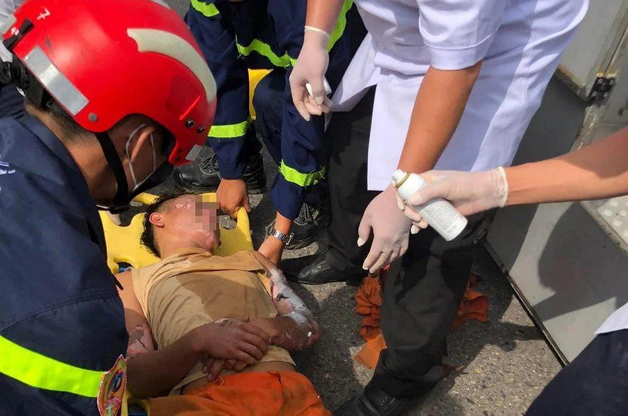 Nam công nhân bị bỏng. Ảnh: H.H