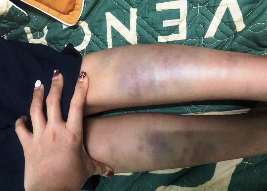 Hình ảnh chân của học sinh bị bầm tím được lan truyền trên mạng. Ảnh: H.H