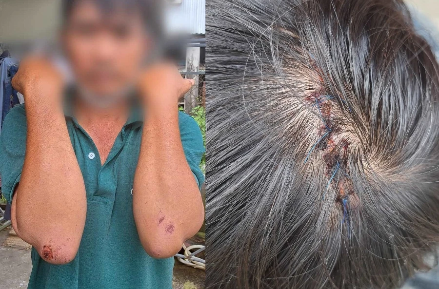 Những vết thương của nạn nhân do nhóm trộm gà gây ra. Ảnh: H.H