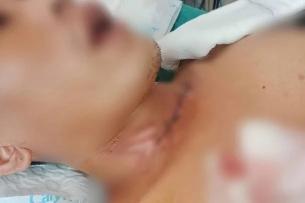 Vết thương ở cổ của anh NVL. Vết thương ở cổ của anh NVL.