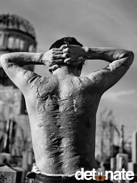 Một nạn nhân của bom nguyên tử ở TP Hisoshima (Nhật).