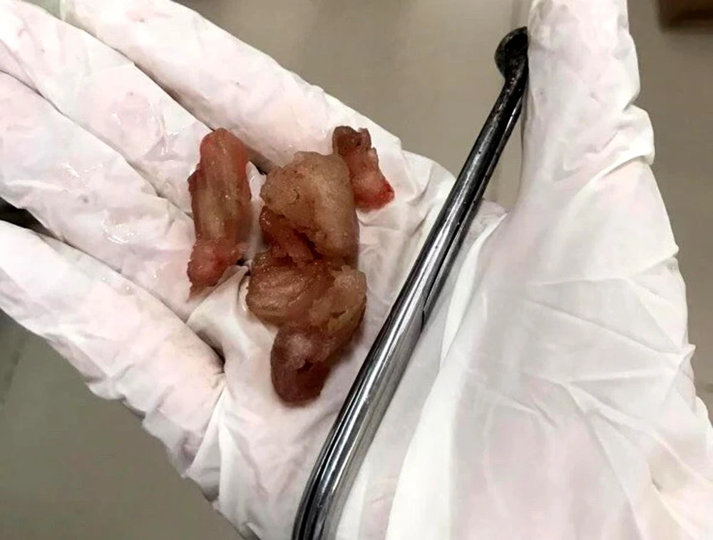 Những miếng mận được các bác sĩ gắp ra. Ảnh: Bệnh viện cung cấp