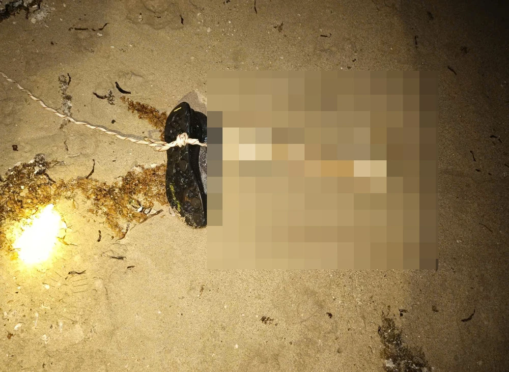 đoạn xương chân 1.jpg