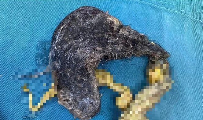 chứng ăn tóc 1.jpg