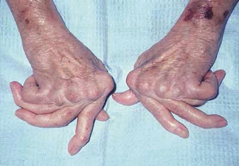 Viêm khớp dạng thấp gây ra nhiều tác dụng nguy hiểm. ẢNH:H.P