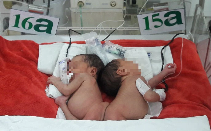 Hai bé sẽ được phẫu thuật tách rời khi tròn 3 tháng tuổi ẢNH: HÀ PHƯỢNG