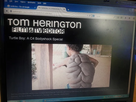 Kỳ lạ cô bé 'lưng rùa' có 232 nốt ruồi trên người ảnh 2