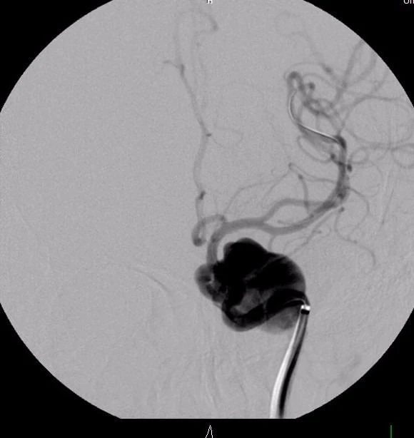 Điều trị túi phình khổng lồ nhờ stent chuyển dòng ảnh 2 Hình ảnh túi phình khổng lồ động mạch não (BV