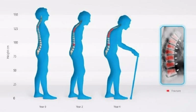 bệnh loãng xương