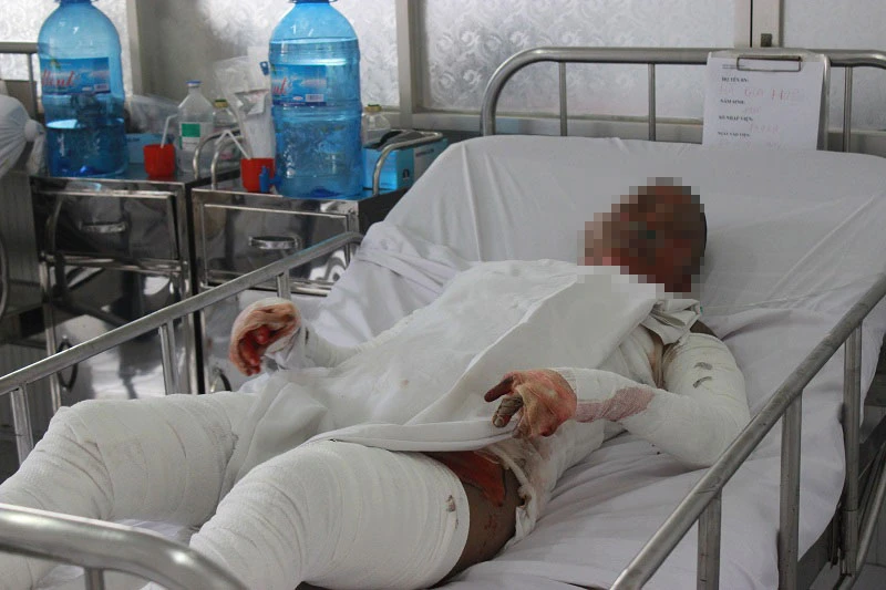 Cô gái bị bỏng nhảy từ lầu 1 xuống đất đang nguy kịch ảnh 1