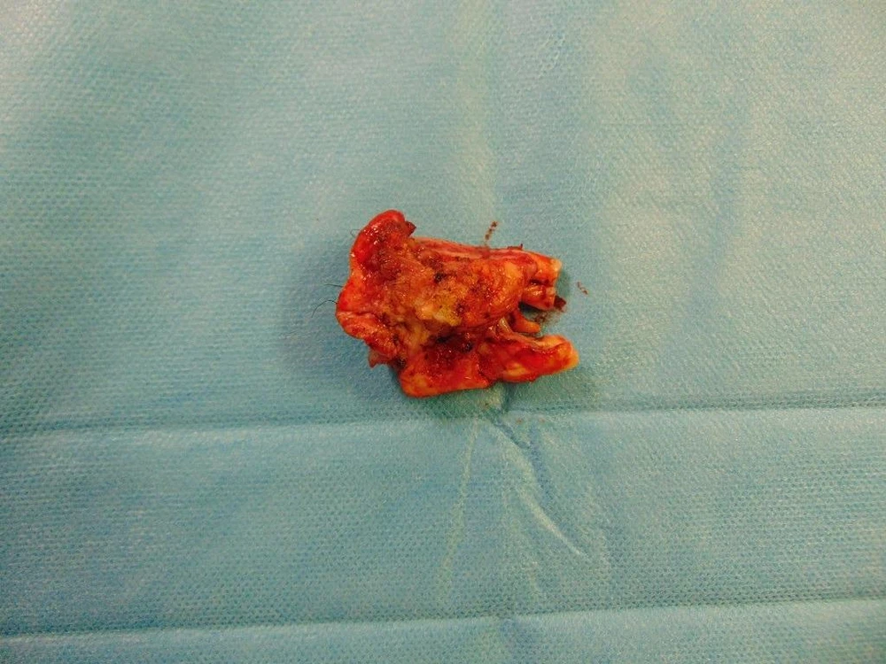 Bác sĩ Đại cùng ekip làm phẫu thuật ngày 14-2