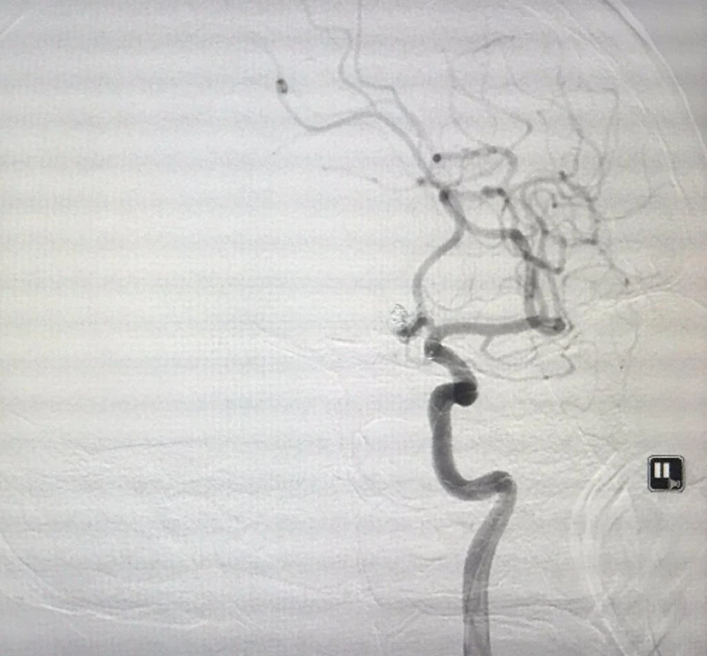 Hình ảnh túi phình đặt DSA sau khi được các bác sĩ can thiệp. 