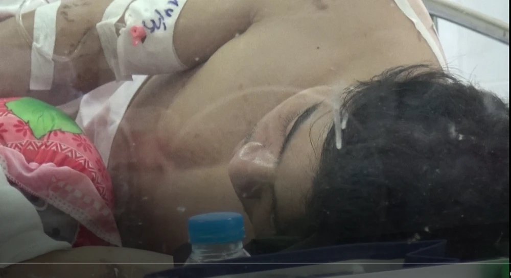 Nổ nhà máy thép: Cả 6 người bỏng sâu, 1 người nguy kịch ảnh 1 Nổ nhà máy thép: Cả 6 người bỏng sâu, 1 người nguy kịch ảnh 1