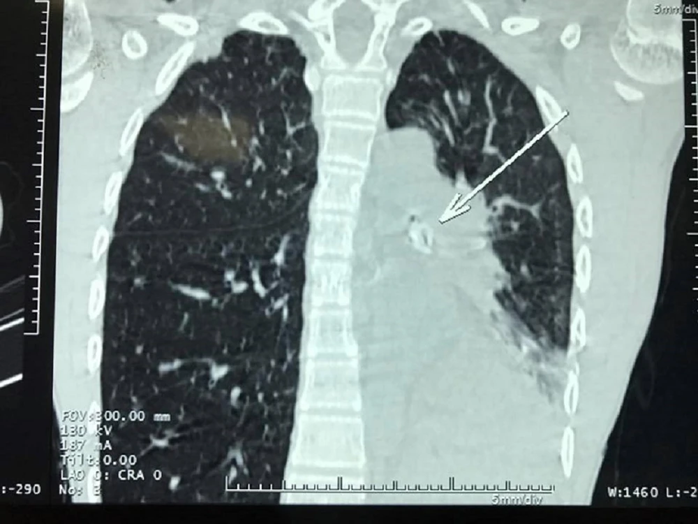 Bé trai suýt chết vì hạt xí muội lọt vào phế quản ảnh 1