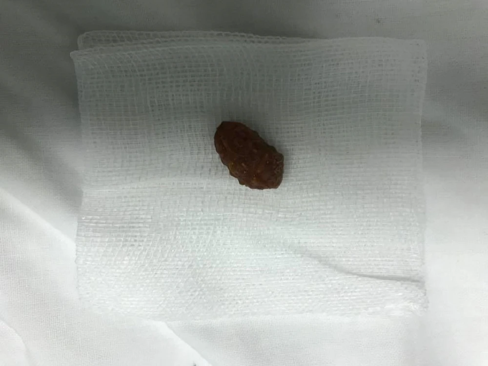 Bé trai suýt chết vì hạt xí muội lọt vào phế quản ảnh 2