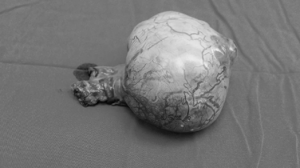 Bị ung thư do tinh hoàn 'đi lạc' trong ổ bụng 20 năm ảnh 2