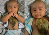 Bé gái bỏng ngực nặng vì... trị sổ mũi bằng lá trầu