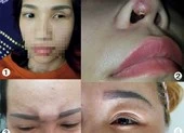 Làm đẹp ‘chui’: Muôn vàn tai biến khóc cười