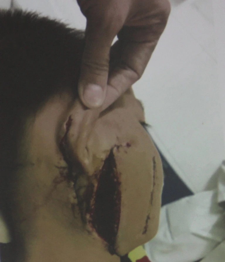 Kinh hoàng bé trai bị cánh quạt công nghiệp cắt thấu xương hàm ảnh 2 Kinh hoàng bé trai bị cánh quạt công nghiệp cắt thấu xương hàm ảnh 2