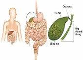 Sỏi mật do đâu mà có?