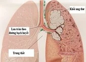 Những dấu hiệu 'tố' bệnh ung thư phổi