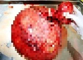 Tự uống thuốc, để khối u xơ nặng tới 4kg