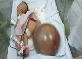 Cân não cắt khối u quái nặng hơn cơ thể bé sơ sinh 