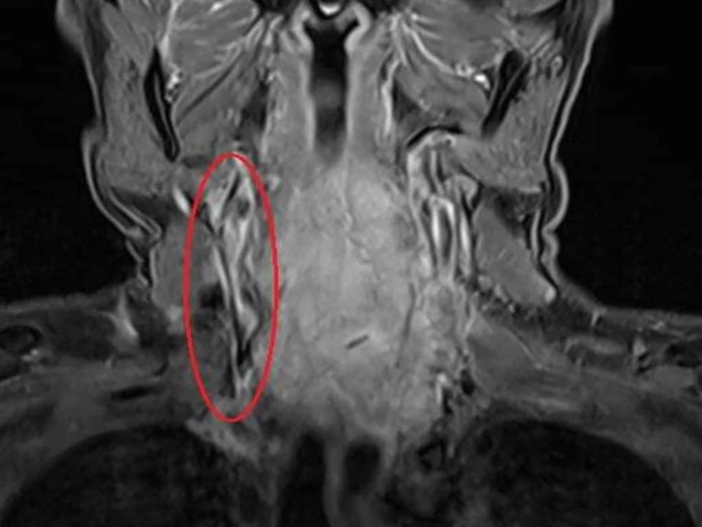 Cắt lể nặn máu độc, người đàn ông nhiễm khuẩn huyết nguy kịch ảnh 2