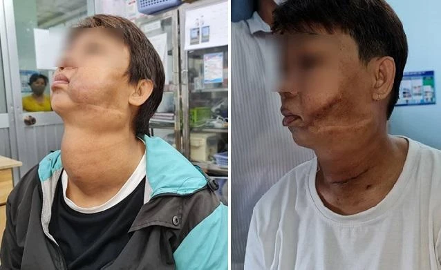 Bệnh nhân trước và sau mổ khối bướu tuyến giáp và mạch máu ở mặt. Ảnh: BSCC Bệnh nhân trước và sau mổ khối bướu tuyến giáp và mạch máu ở mặt. Ảnh: BSCC