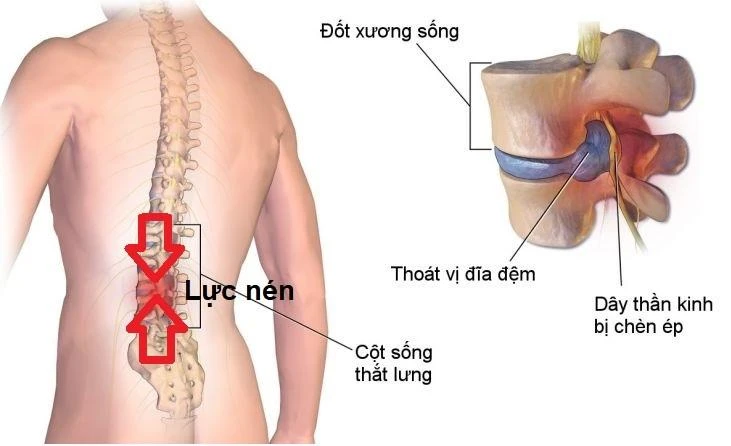 Thoát vị đĩa đệm vùng cột sống thắt lưng thường gặp nhất. Ảnh: BSCC
